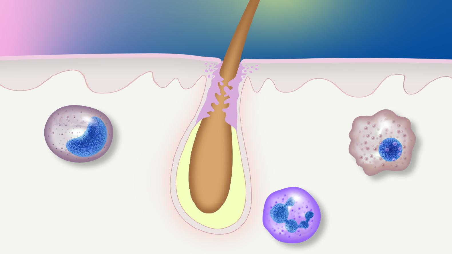 Pathophysiology of Hidradenitis Suppurativa: From Follicular Occlusion to Tunnels  